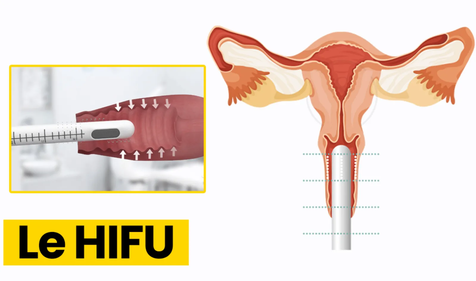 HIFU Vaginal – gynécologue à Marrakech