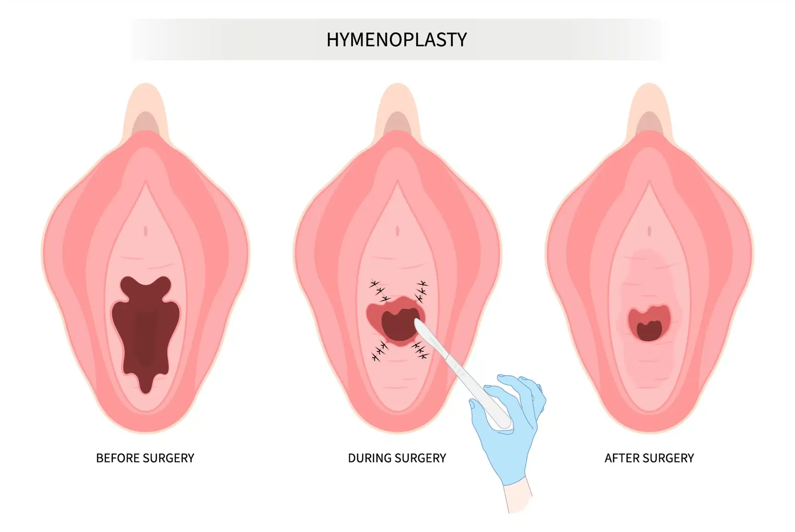 Hyménotomie – gynécologue à Marrakech