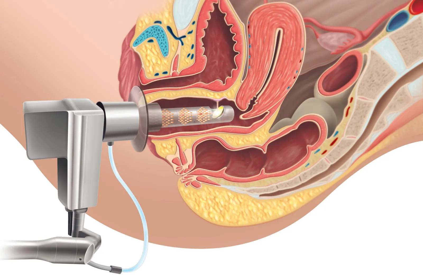 Laser CO2 Vaginal & Nymphoplastie – gynécologue à Marrakech