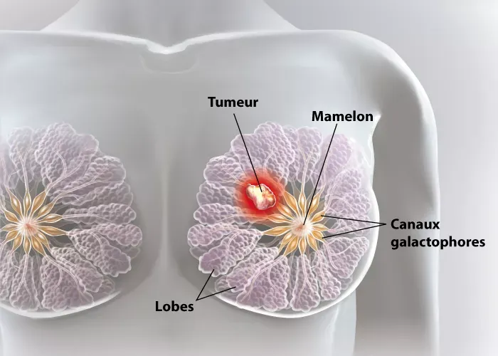 Sénologie et chirurgie gynécologique – gynécologue à Marrakech